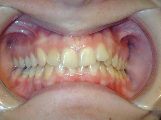 Συνωστισμός σε επάνω και κάτω οδοντικό τόξο