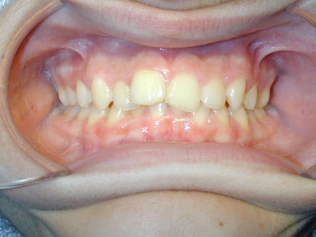 Συνωστισμός σε επάνω και κάτω οδοντικό τόξο